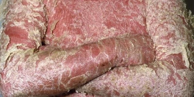 Vẩy nến là bệnh da liễu phổ biến thường gặp ở người Việt Nam Vẩy nến là bệnh da liễu phổ biến thường gặp ở người Việt Nam